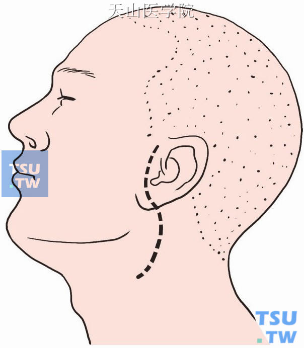 切口线紧靠耳屏前方，再转向耳垂后方，越过乳突，向下至颈部