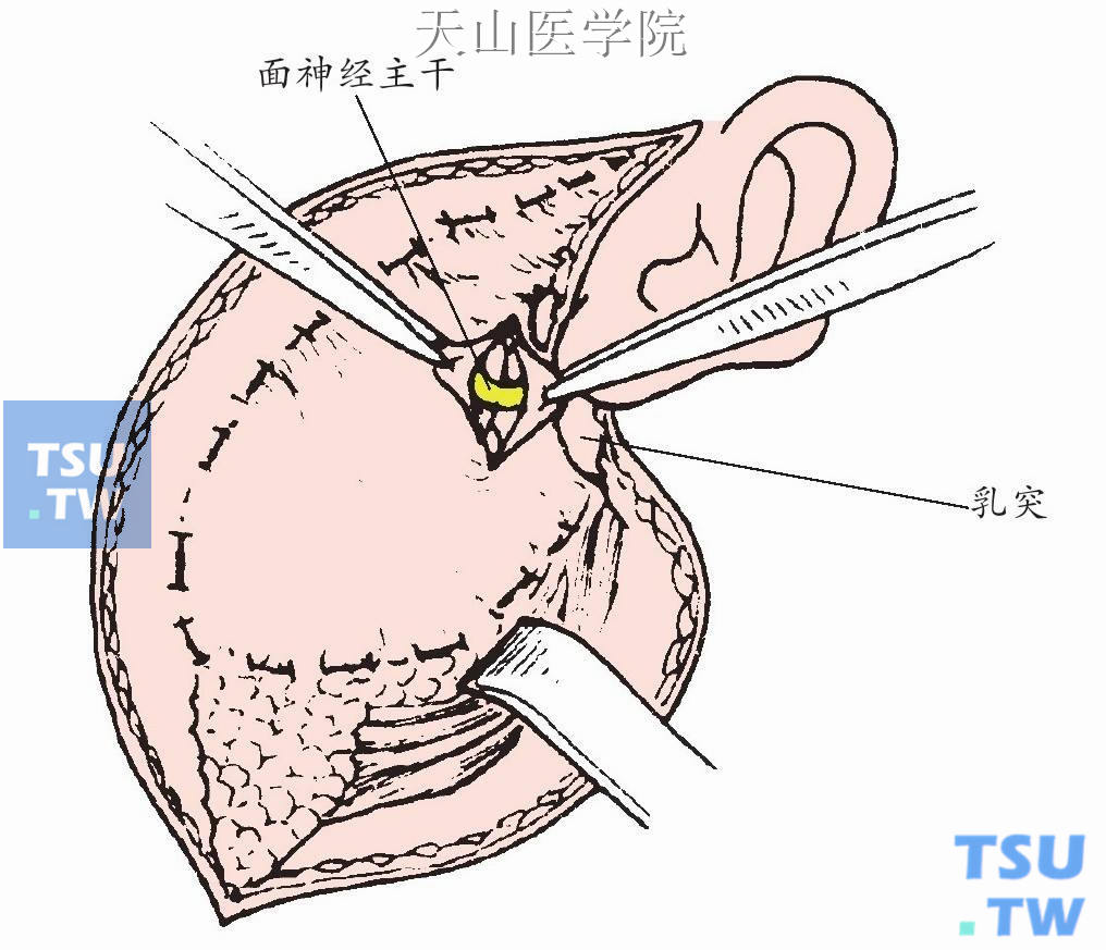 可在面神经离开茎乳突孔处，在二腹肌后腹与外耳道软骨所构成的角之间寻找面神经