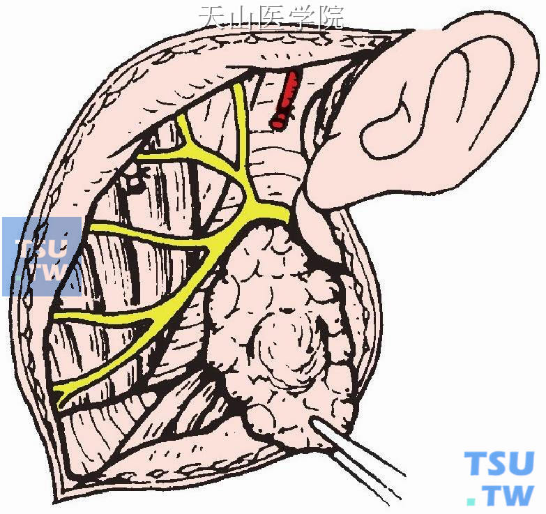 将腮腺深叶与周围组织分离，并与面神经分开