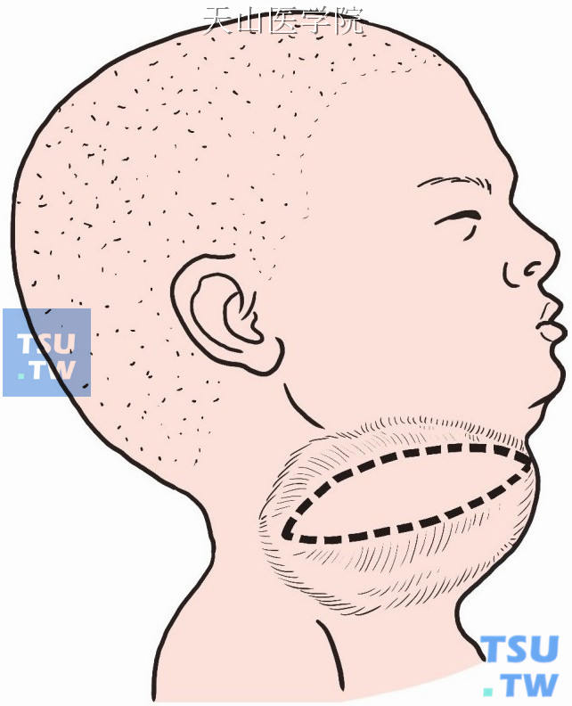 于颈部囊状淋巴管瘤表面，沿皮纹做横梭形切口，其长度以超过囊肿缘为宜。囊肿小者可做横形切口