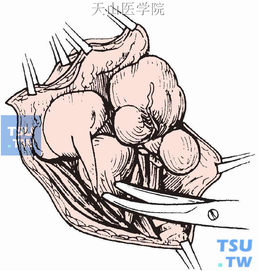 操作时不宜用器械夹持，最好用手与纱布压持囊肿，或用组织钳钳夹切除部分皮肤，以做牵引。沿包膜做锐性、钝性分离，囊肿浅部较易分离