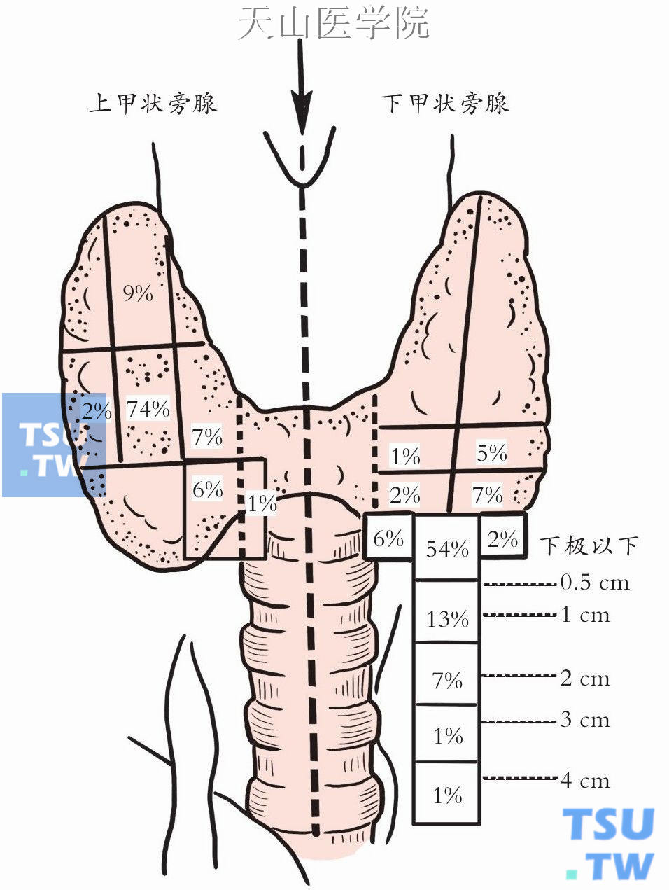 下甲状旁腺分布范围更广泛，多数邻近甲状腺下极
