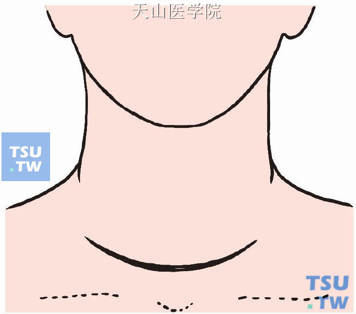 切口同甲状腺次全切除术，取低位领形切口