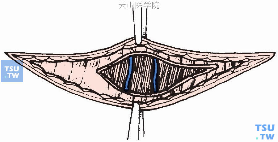 显露颈前肌及颈前静脉