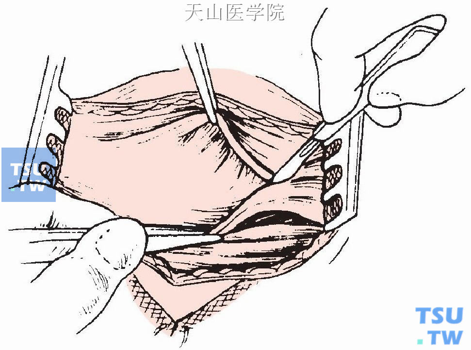 于颈部正中切开颈白线，将颈前肌向两侧牵开，上至甲状软骨，下至胸骨上凹