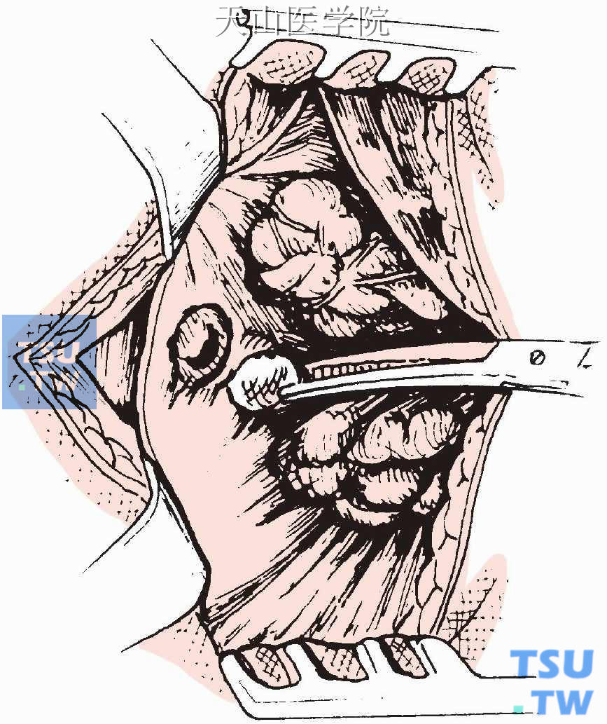 显露右侧上甲状旁腺腺瘤，包膜光滑、发亮、呈牛肉红色。肿瘤与周围组织无粘连