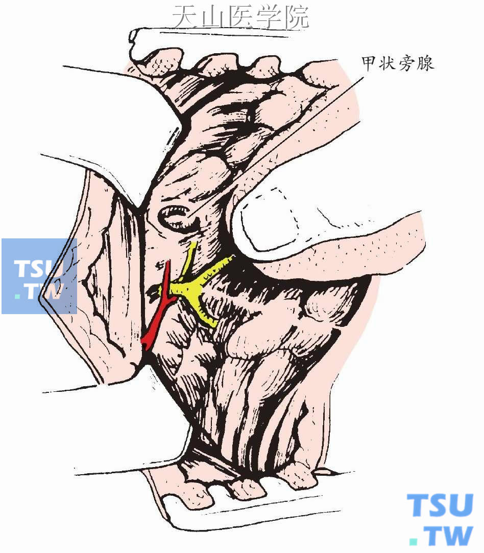 右侧甲状旁腺腺瘤的典型部位，靠近喉返神经和甲状腺下动脉交叉点