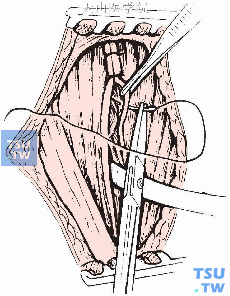 间断缝合颈白线，间断缝合颈阔肌及皮下组织