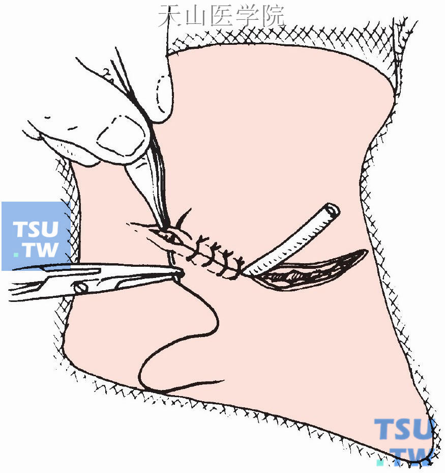 间断缝合皮肤切口，创口置皮片管引流