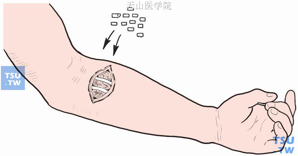 将其中一枚甲状旁腺切成1mm×1mm×3mm的小块，在一侧前臂屈肌内植入15～20小块