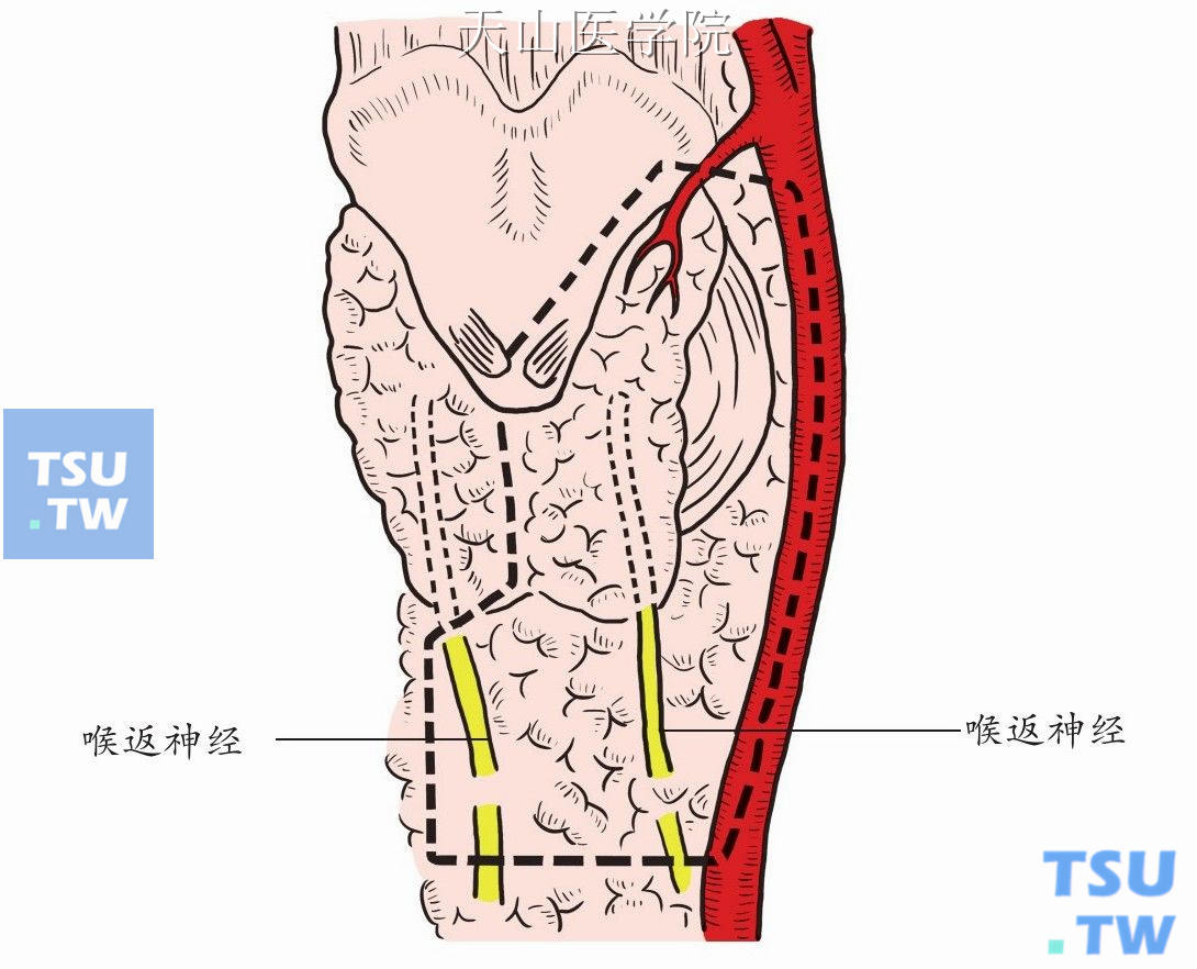 虚线内肿瘤连同患侧甲状腺叶、峡部以及颈总动脉内侧、气管前方淋巴结脂肪组织一并切除