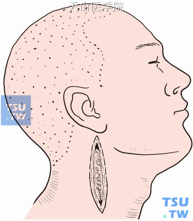 自下颌角平面开始，沿胸锁乳突肌前缘向下，到胸锁关节处，做斜形切口
