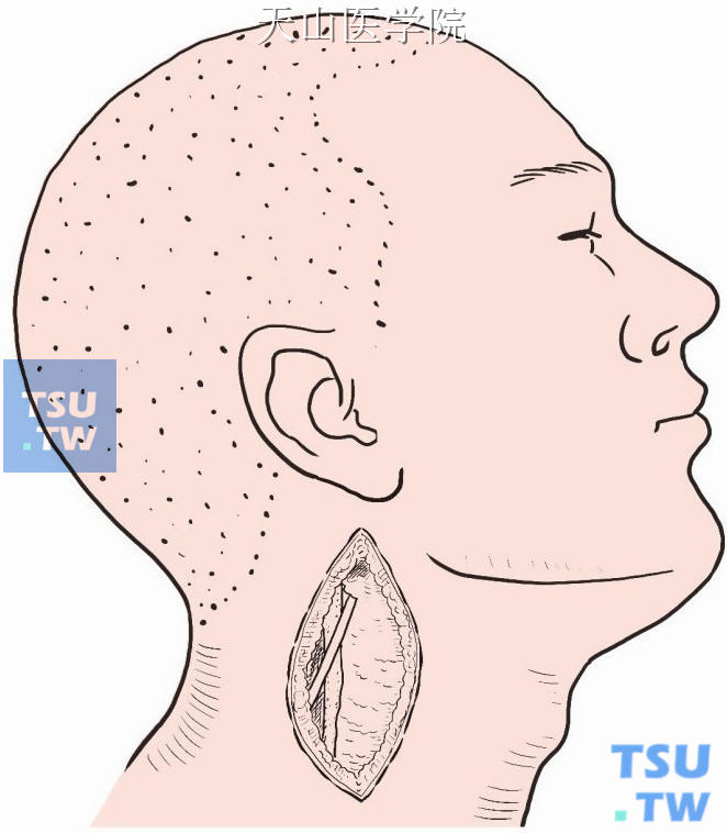 切开皮肤、颈阔肌，显露胸锁乳突肌前缘