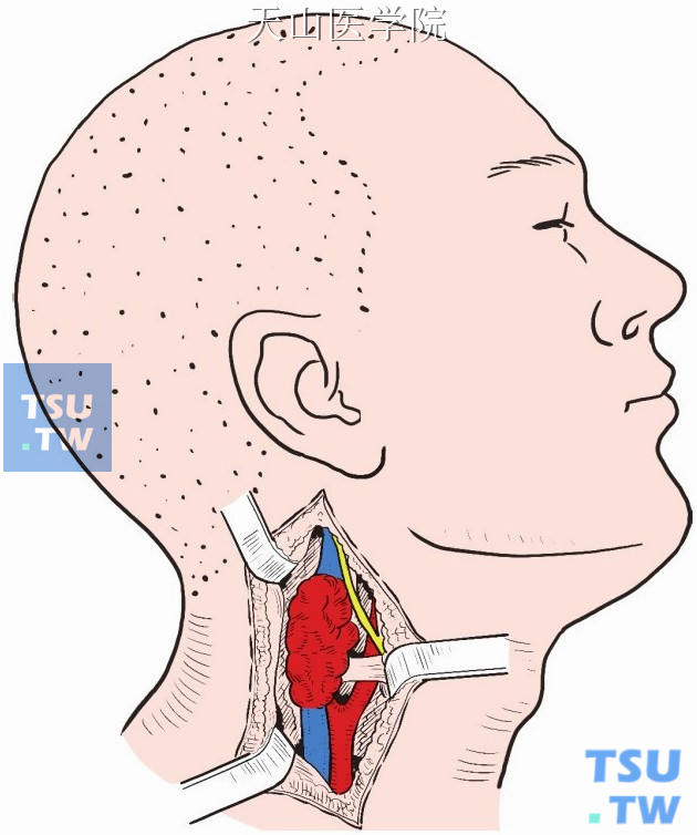 沿胸锁乳突肌向深面分离，用拉钩向两侧牵开，即可显露颈动脉体瘤