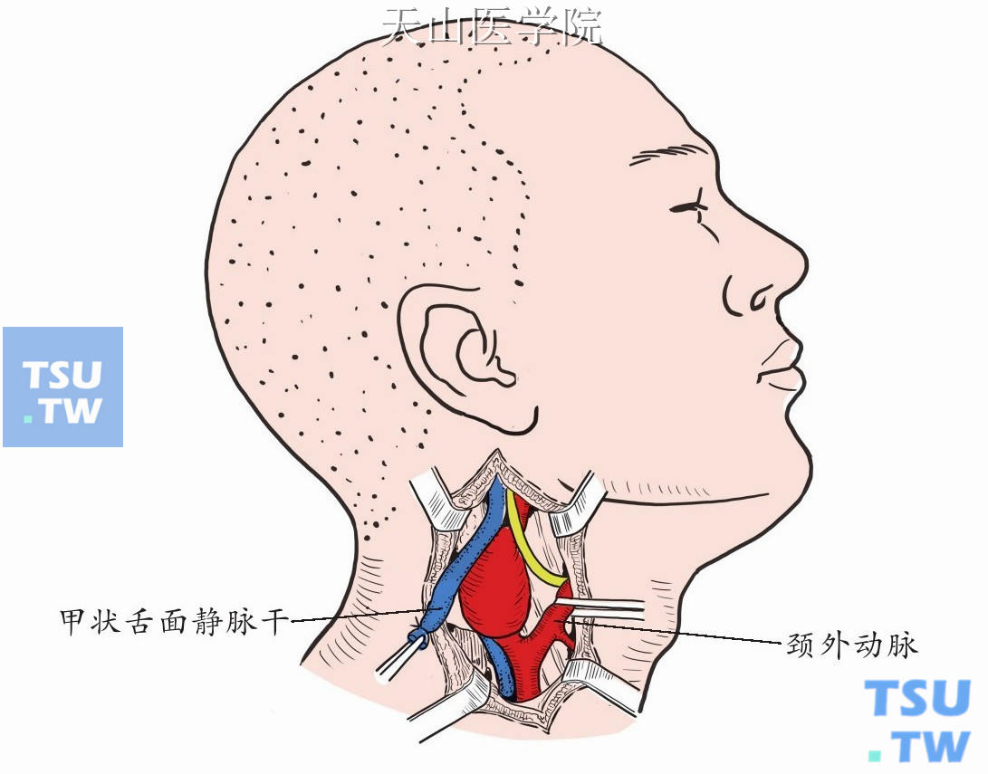 切断甲状舌面静脉干，利用其断端向外牵拉颈动脉体瘤，游离颈外动脉后，用橡皮条将颈外动脉拉向内侧