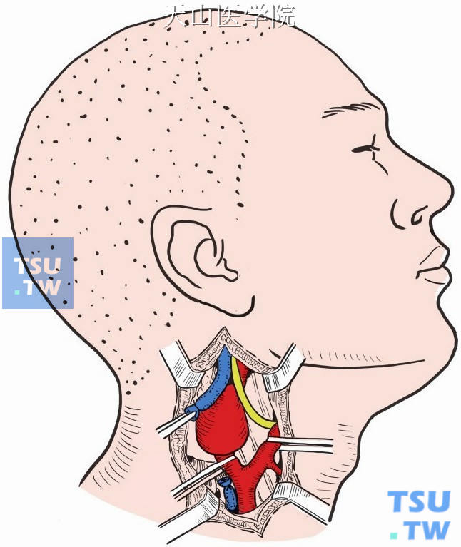 在颈动脉体瘤下方结扎、切断颈内静脉，将其断端向前牵开。分离颈内动脉，再用小橡皮条将颈内动脉提起，并沿颈内动脉外膜向上剥离