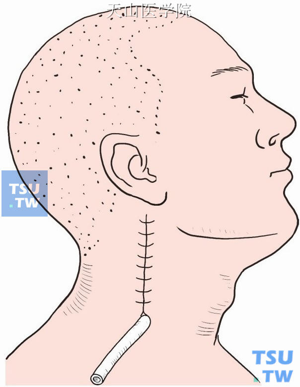 创口局部置皮片管引流，间断缝合颈阔肌、皮肤