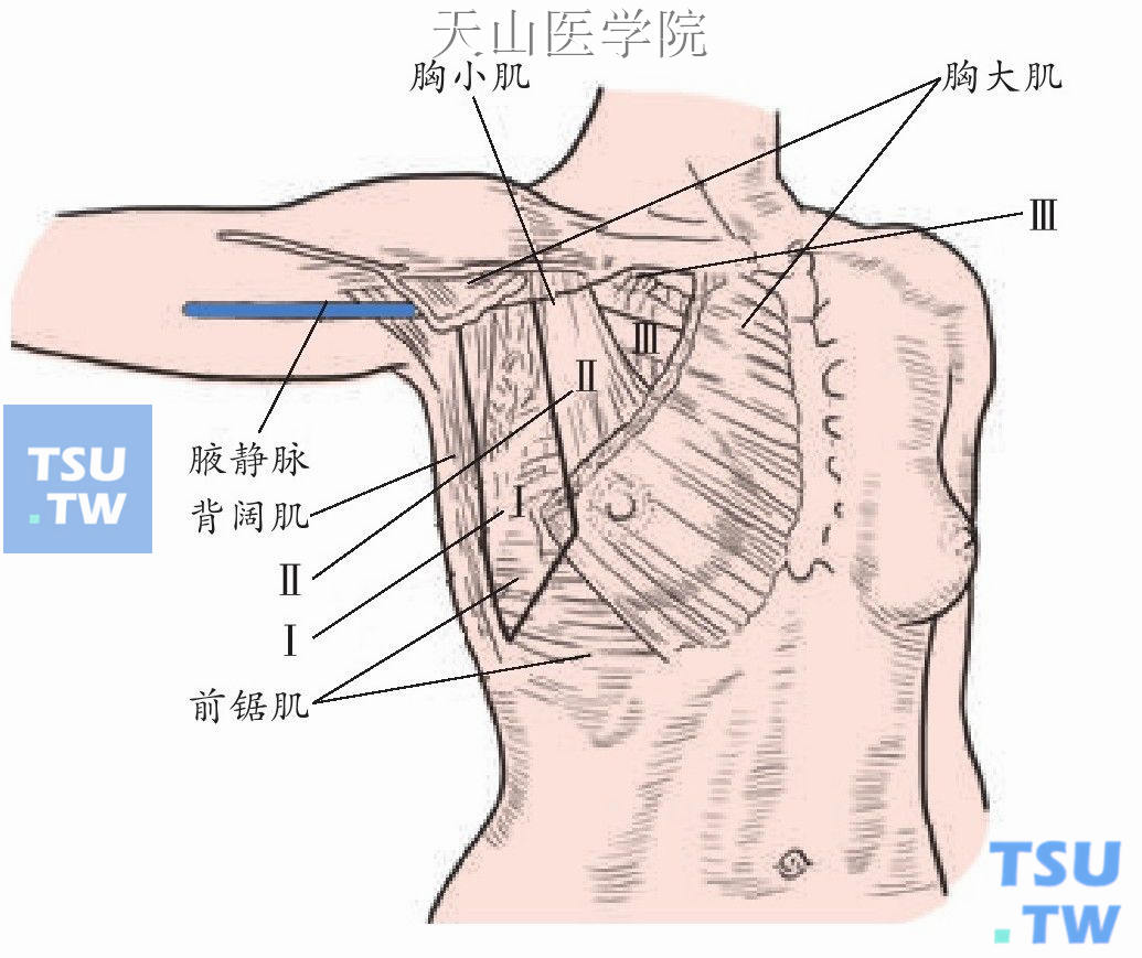 腋窝淋巴结分组