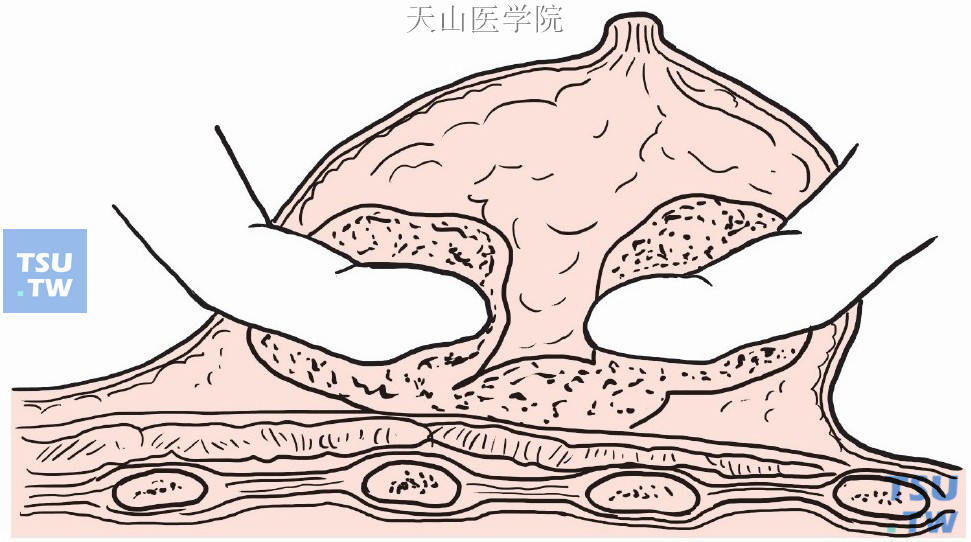 乳房脓肿以示指分开间隔，达到彻底引流