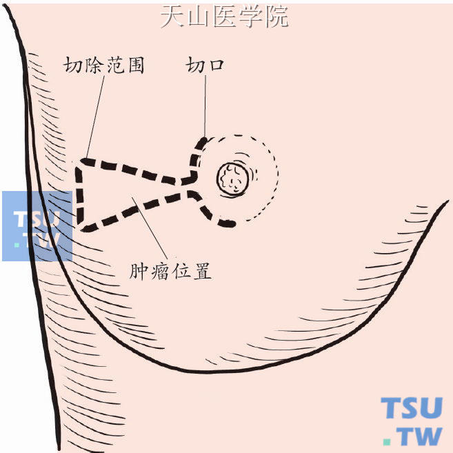 以肿块为中心与周围少量乳腺组织一并楔形切除