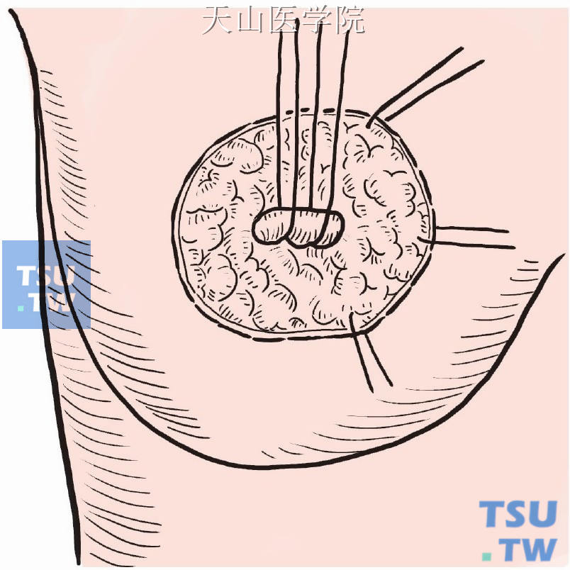 在乳腺组织与皮下组织之间，向四周游离皮瓣至适当范围，充分显露肿块及周围乳腺组织