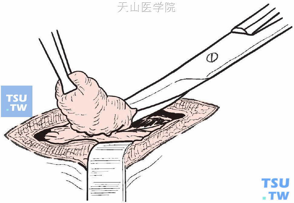 以组织钳夹住肿块后，将肿块提起，用手术刀或剪刀在肿块两侧呈梭形切开乳腺组织
