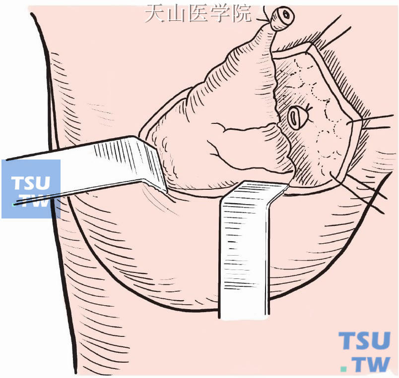 如在肿瘤基底部遇有输乳管被切断，则应缝扎，以防乳瘘