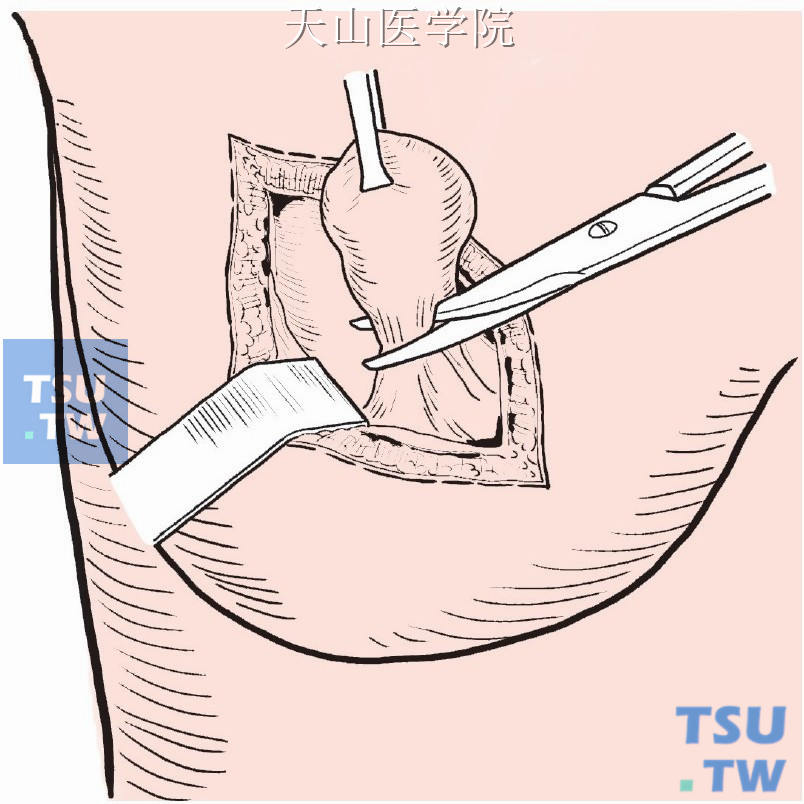 乳房肿瘤及周围乳腺组织一并行楔形切除