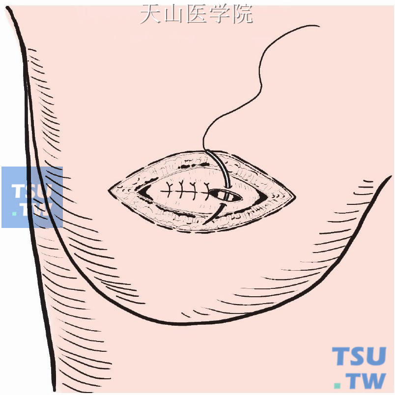 乳房创面做贯穿底部的间断缝合