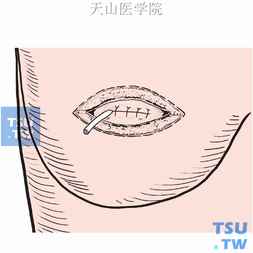 若乳房肿瘤较大，出血较多，切口较大，则可在缝合皮肤前放置引流