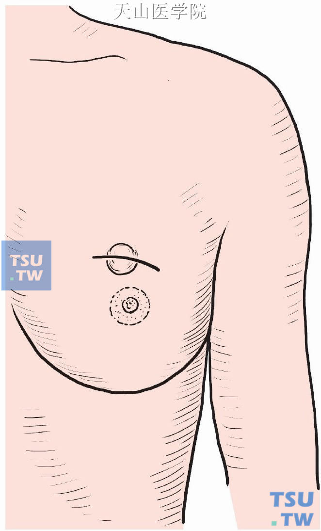 不论肿瘤位于乳房什么部位，均采用弧形切口。腋窝清扫时另做切口。切口直接置于肿瘤之上，设计切口必须考虑到做乳房切除术的可能性，两者切口要能吻合