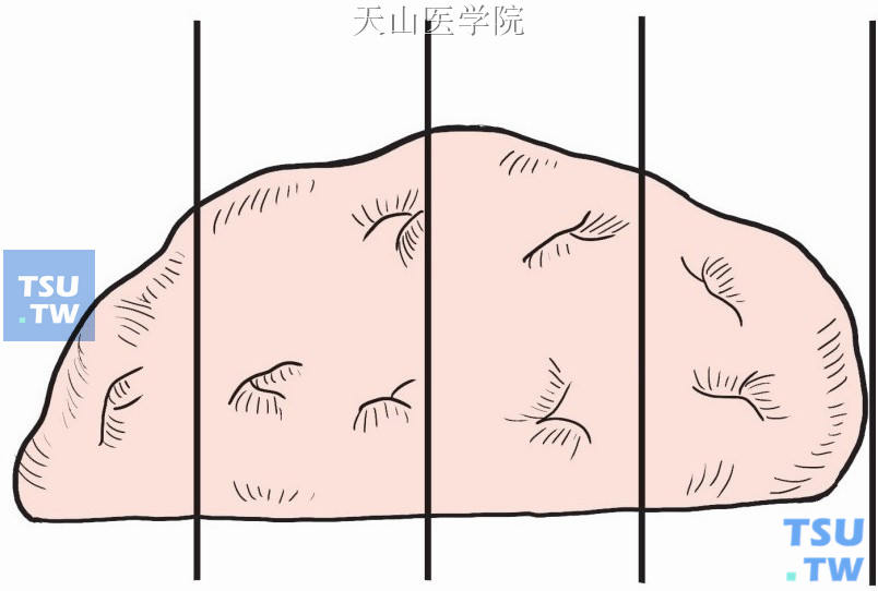 矢状切开半球形组织块