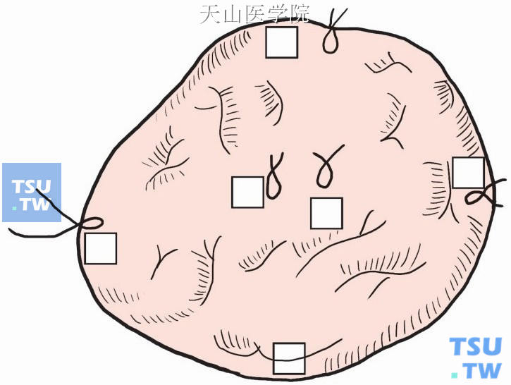 简化“6”点取材标记法