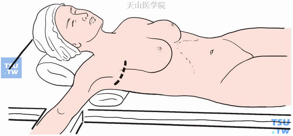 乳房部分手术结束后开始腋窝清扫，于腋窝毛发区下缘做横弧形切口，后方稍超过腋中线，前方超过胸大肌边缘3～4cm