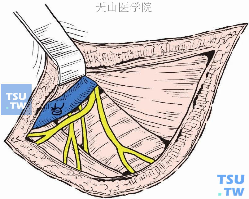 胸背及胸长神经仍保留