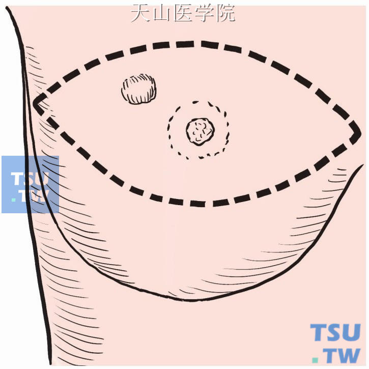 以乳头为中心，做横梭形切口