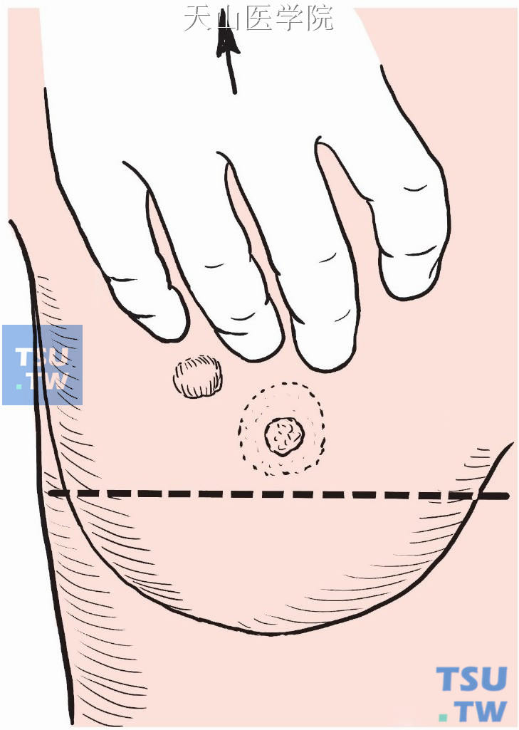 拟定切口时，可先将乳房尽量上提，沿乳晕下方画一水平线