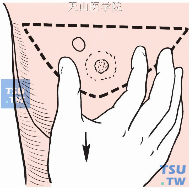 切口线离肿块边缘不应小于3cm