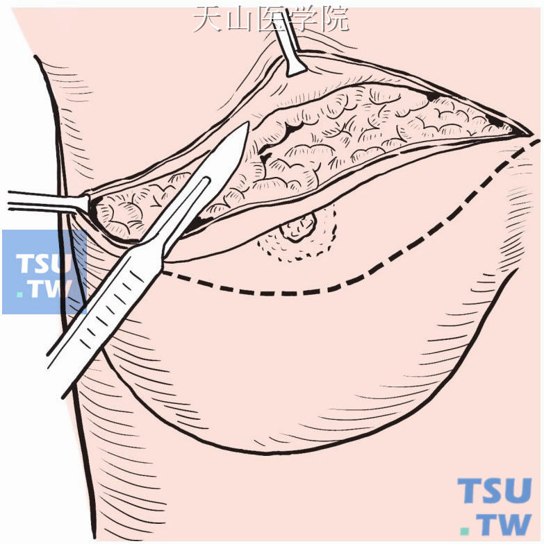以手术刀或电刀在皮肤及皮下脂肪之间做潜行分离