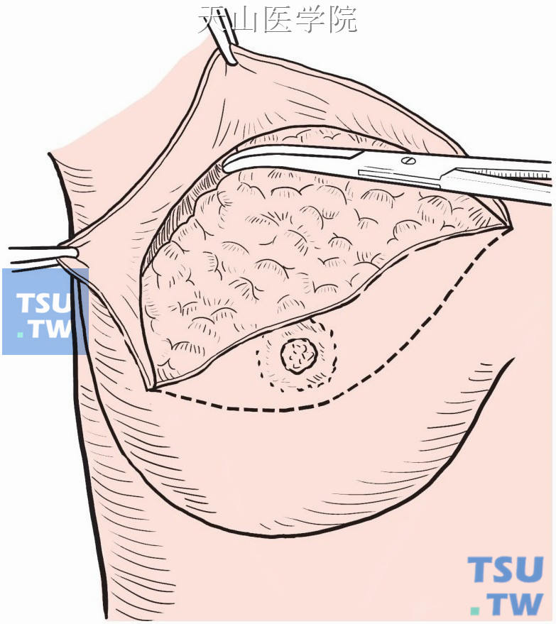 乳房切除术 割掉图片