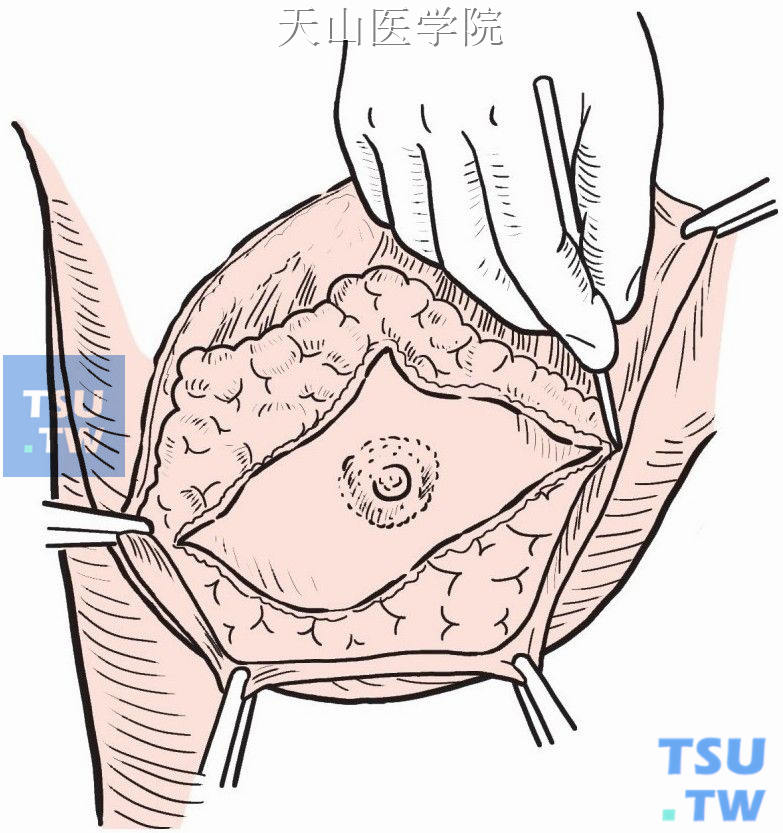 同样以手术刀或电刀分离下皮瓣
