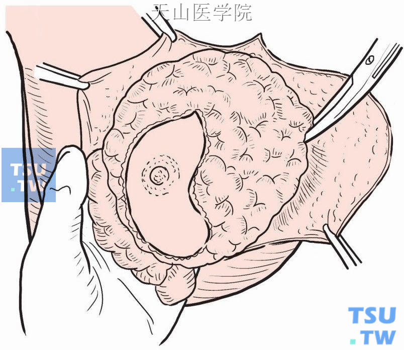 乳腺内侧缘自胸骨边缘及肋软骨部分离，自内向外将乳腺从胸壁分离