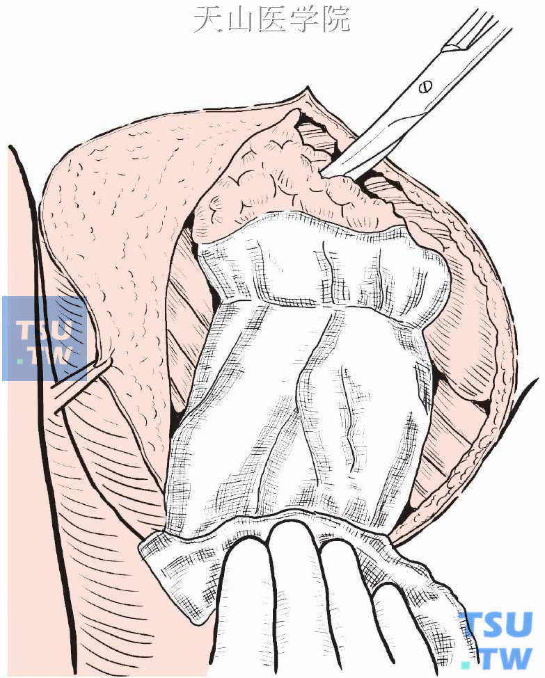 分离乳腺侧方，抵背阔肌前缘，至此乳腺完全游离，仅其腋尾部与胸壁相连
