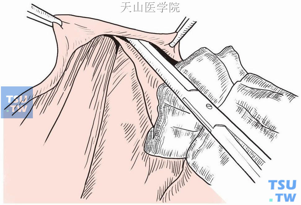 牵开上皮瓣，以组织剪分离腋尾部前面。分离平面靠近乳腺组织，以免剪破皮肤