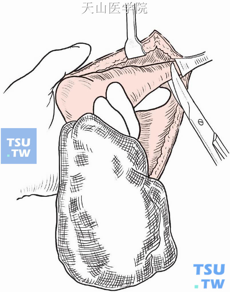 将腋尾部从前面与胸大肌分离，后面与背阔肌分离，于高位切断腋尾部组织