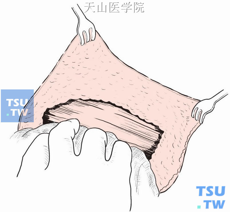 将乳腺与胸大肌筋膜一并自内侧向外侧分离