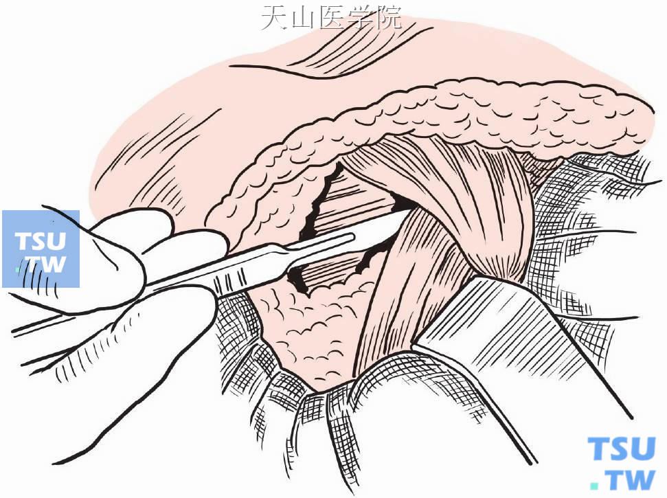 分离切除胸大肌与胸小肌之间的淋巴结脂肪组织，分离切除胸小肌外侧及深面的淋巴结脂肪组织