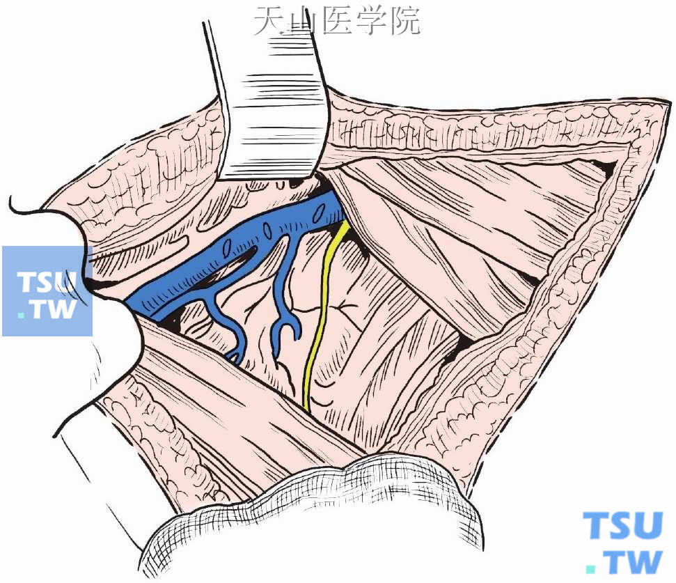 腋静脉以下，胸小肌内侧及背阔肌前方区域内淋巴结脂肪组织均已清除