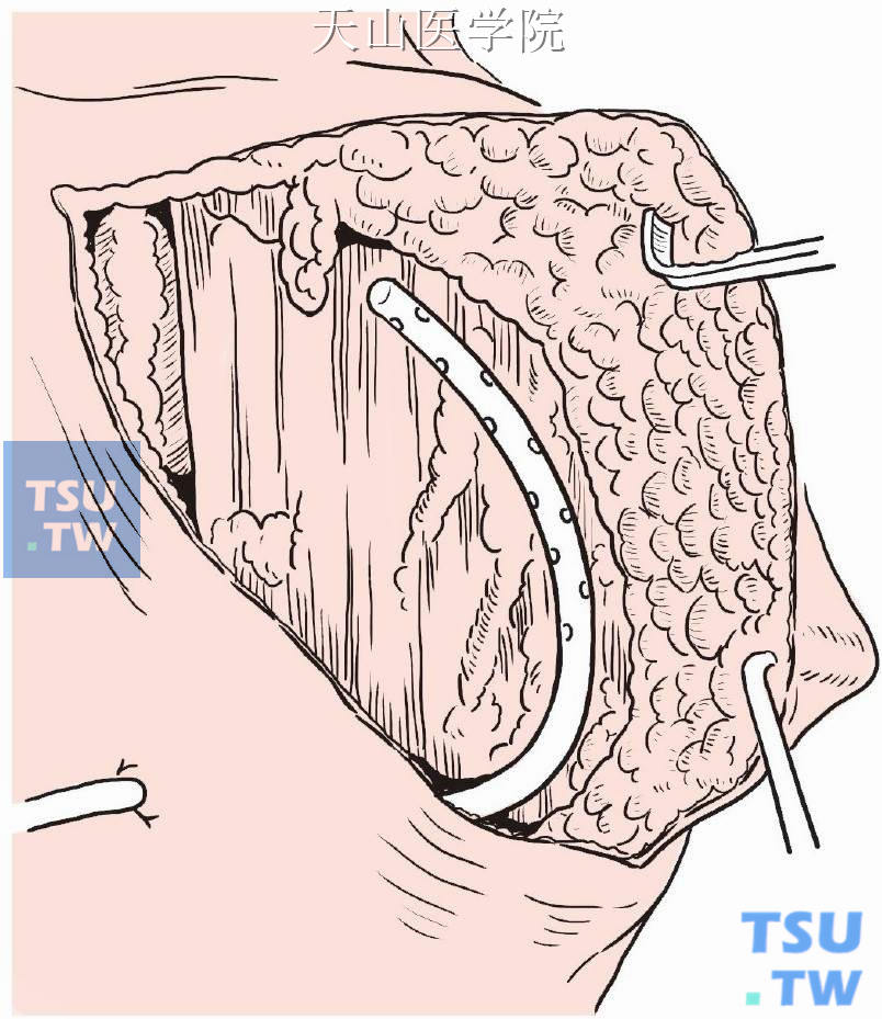 创口止血、清洗后放置引流管
