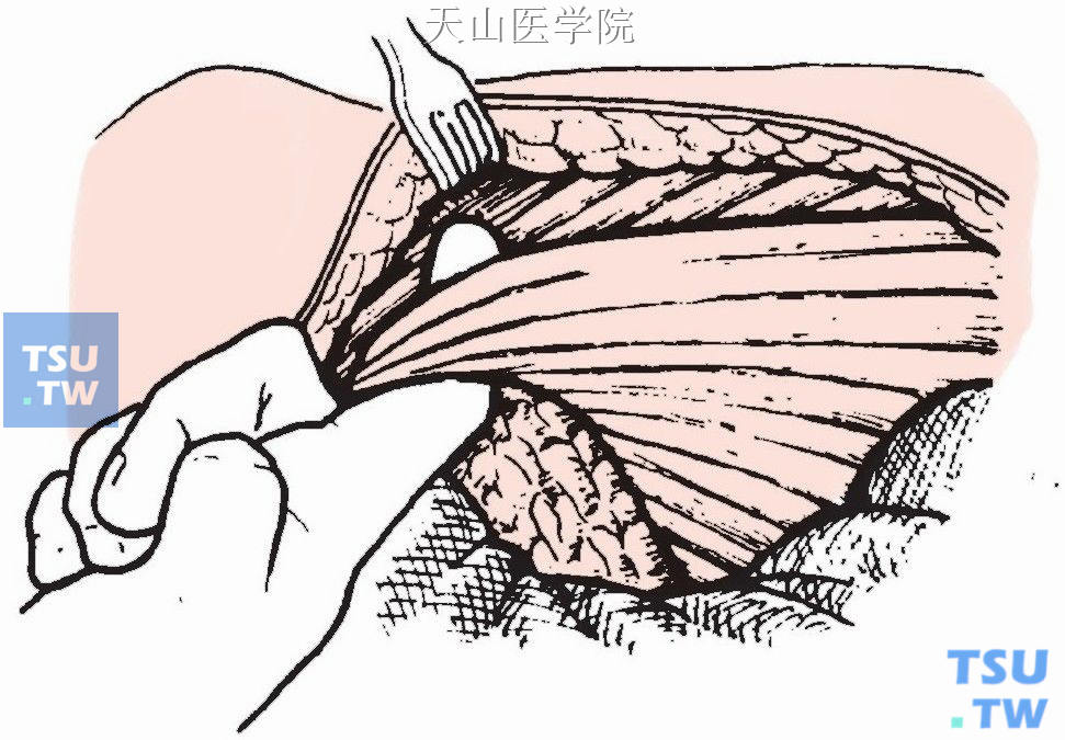 切口、分离皮瓣同本章第六节“乳腺癌改良根治性切除术”，皮瓣分离结束后，于锁骨下方约一横指宽处，沿肌纤维方向由内向外钝性分开胸大肌，直至其止点处，以示指挑起胸大肌肌腱，靠近止点处切断